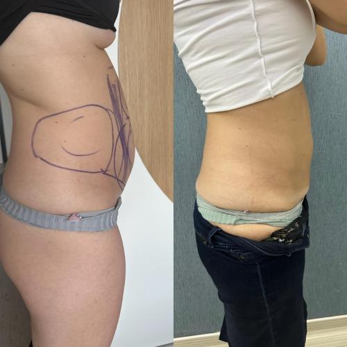J plasma Renuvion Before / After photo